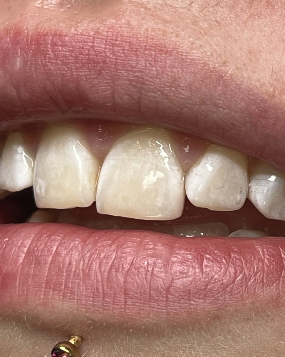 Tooth gem: een kristal op een tand